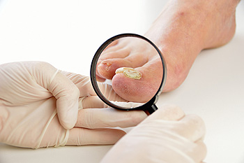 Preventing and Treating Toenail Fungus